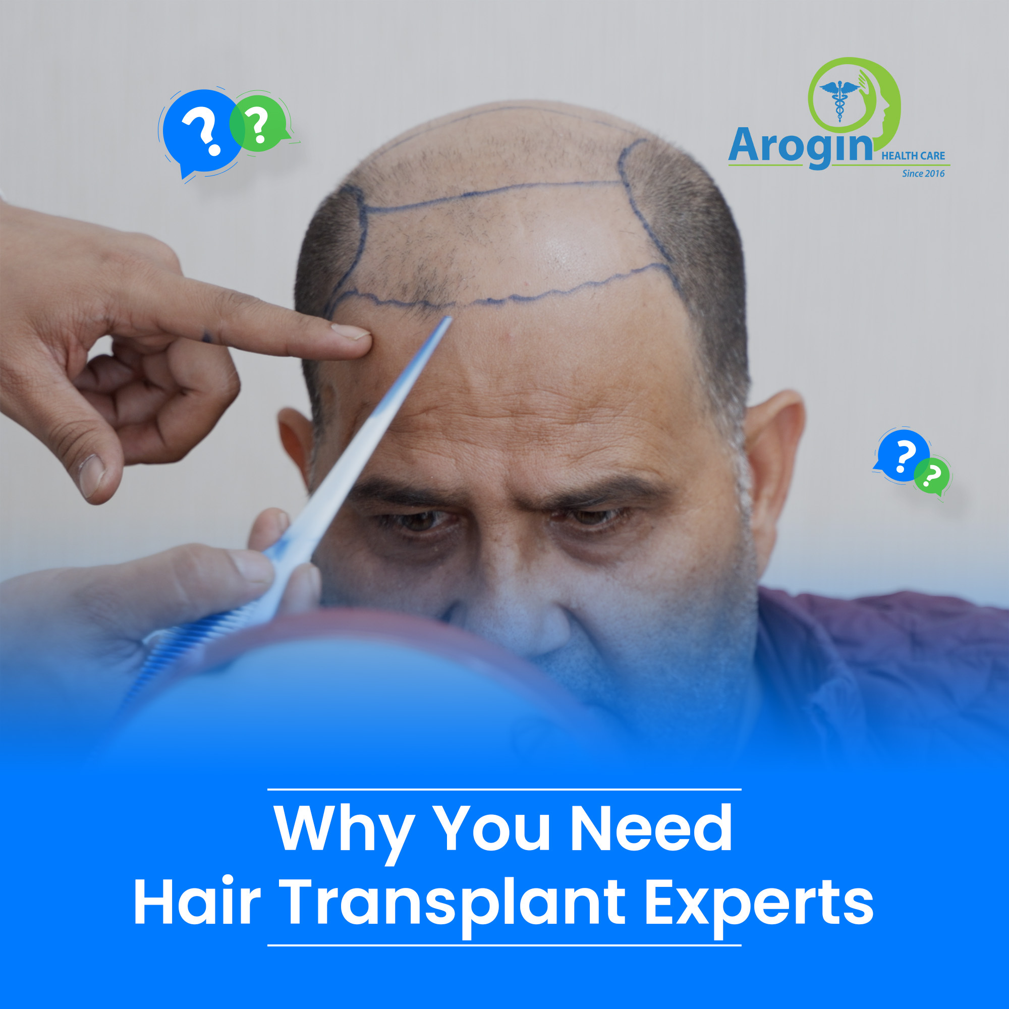 Why You Need Hair Transplant Experts